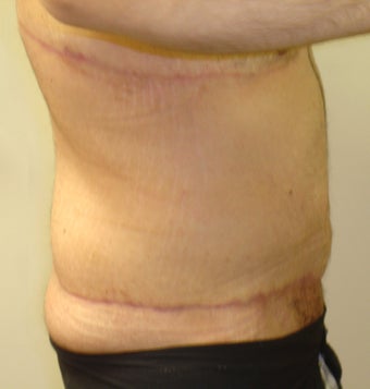 Bodylift & removal of excess chest skin 527247