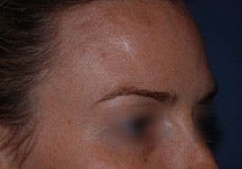 Botox 555513