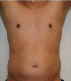 Smartlipo Abdomen before 123636