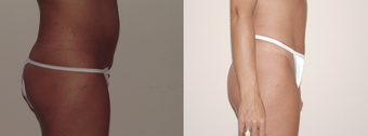 Mini abdominoplasty 377269