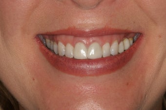 Smile Makeover: Porcelain Veneers before 94818