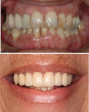 Full porcelain crowns before 109488