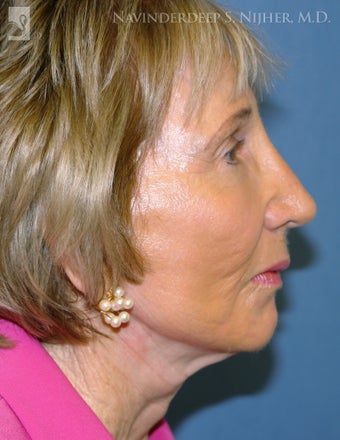 Facelift, Brow Lift & Eyelid Surgery after 502431