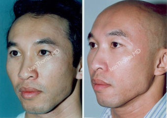 Non-Surgical Face Lift- Exoderm before 242998