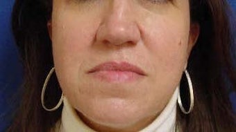 Rhinoplasty before 321766