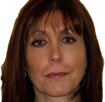 Facial Fat Injections after 296459