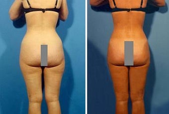 Liposuction before 636229