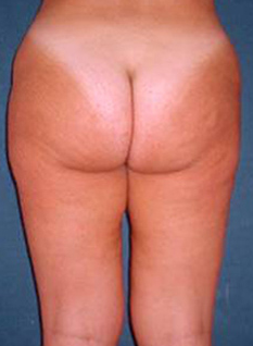 Butt Lift before 230706