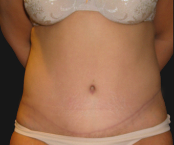 Abdominoplasty after 458935