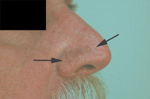 Vein removal on the nose with laser treatments before 106549