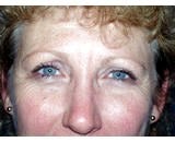 Eye Lid Lift Surgery (Blepharoplasty) after 155478