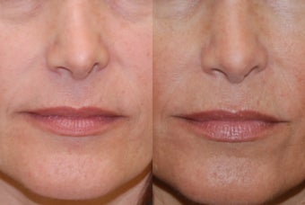 Non-Surgical Rhinoplasty with Silikon-1000. Nostril lowering after previous rhinoplasty surgery. before 354518
