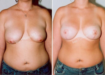 Mastopexy-Breast Lift before 243730