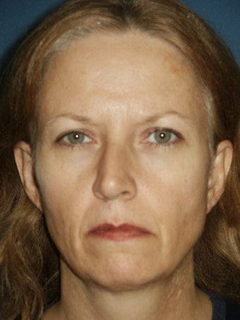 Facelift, Anterior Hairline Browlift, Bilateral Lower Blepharoplasty, Chin Augmentation with placement of extended chin implant, before 249144