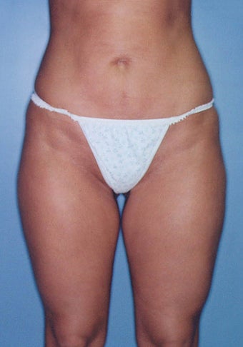 Power Assisted Liposuction (Hips, Thighs, Stomach & Back) after 276641