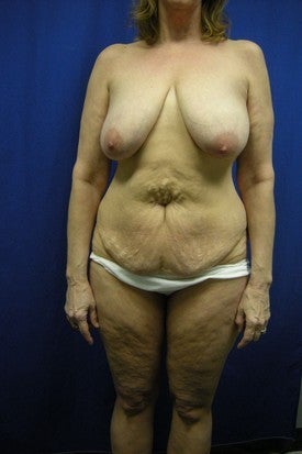 Full Abdominoplasty and Breast Lift with Implants before 381787