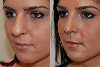 Rhinoplasty Surgery before 204596