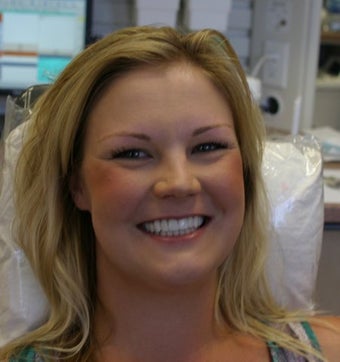 Upper arch make over with veneers and crowns 625407