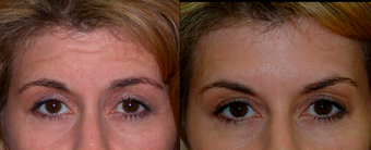 Botox before 306861