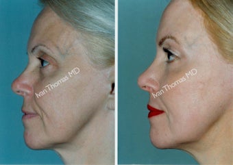 Non-Surgical Face Lift- Exoderm before 242979