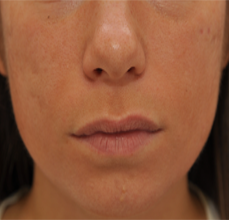 Acne Scarring before 426033
