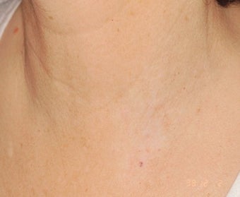 PDL for port wine stain after 374578