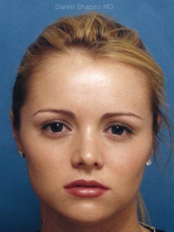 Rhinoplasty with refinement of the nasal tip and nasal dorsum and lip augmentation with placement of Alloderm grafts. ( after 249106