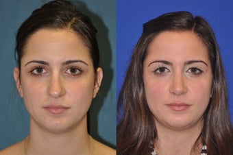 Rhinoplasty before 256037