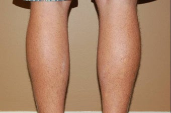 calf implants before 258894