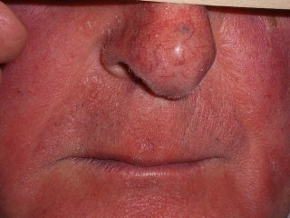 Basal Cell Carcinomas Excisions before 272098