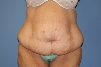 Abdominoplasty after massive weight loss before 91275