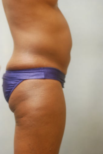 SmartLipo Abs & Love Handles before 356690