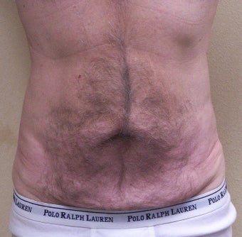VASER Shape to Abdomen before 433039