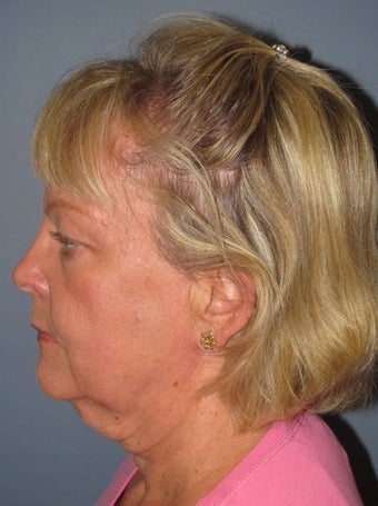 Neck Lift, Platysmaplasty 634748
