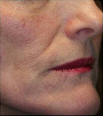 Fraxel - Photoaging after 652367
