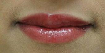 Lip Augmentation after 224919