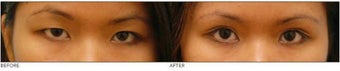 Asian Blepharoplasty ("Double Eyelid" Procedure) before 136816