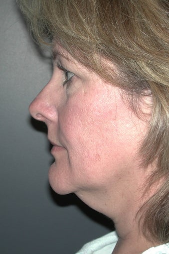 Facelift before 137858