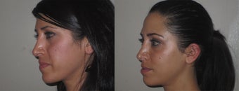 Facial Rejuvenation, non-surgical after 450123