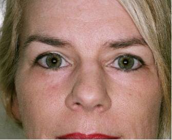 Eyelid rejuvenation after 378932
