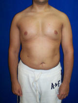 Pec Implants after 130082