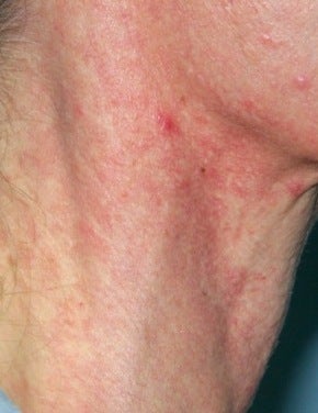 Vbeam laser treatment before 374531