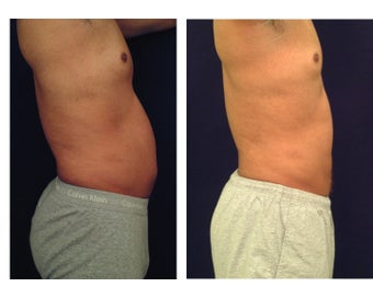 Liposuction 397015