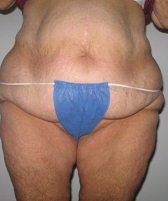 Body lift, tummy tuck, liposuction before 613990