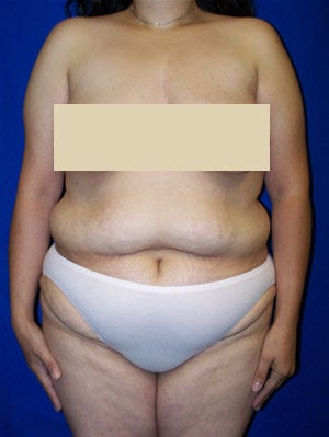Extended Abdominoplasty Surgery before 98496