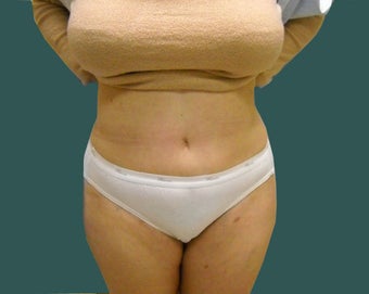 Extended abdominoplasty after 561153