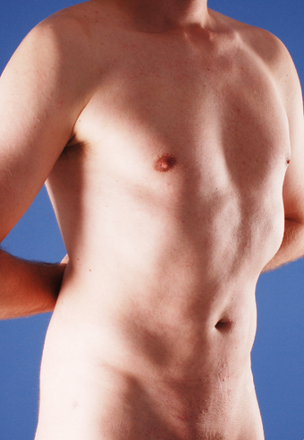 Tummy Liposuction after 229671