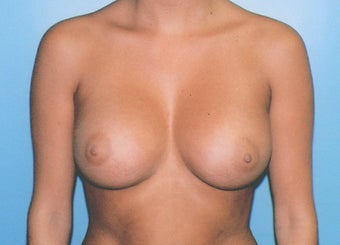 Breast Augmentation - Small B Cup to Small D Cup after 297500