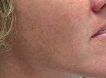 Photofacial Laser Treatment before 374393