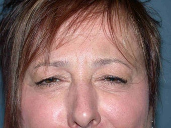 Dysport injections after 109694